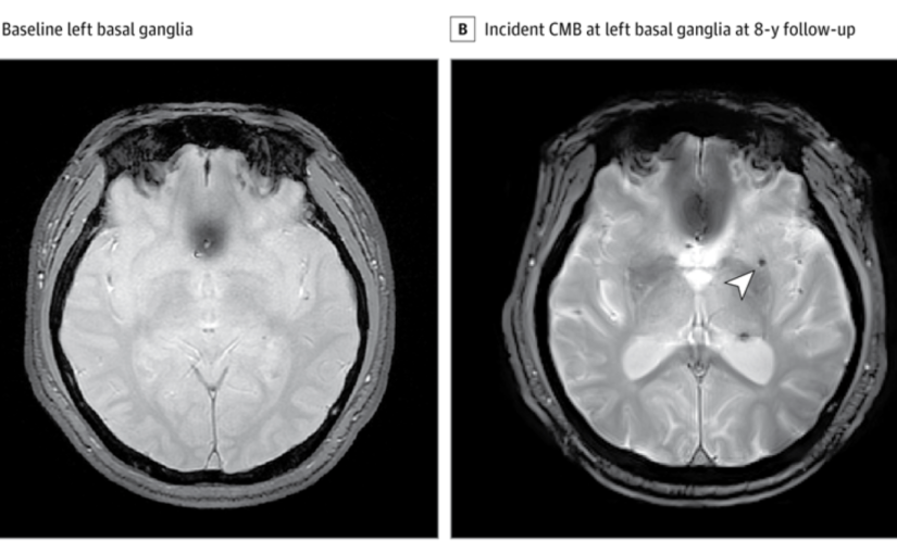 Quick read: Sleep apnea and bleeding in the brain